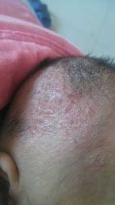 小儿头皮湿疹健康经验（小儿头皮湿疹症状图片）-图2