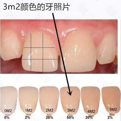 最健康牙齿（健康牙齿的标准颜色）-图2