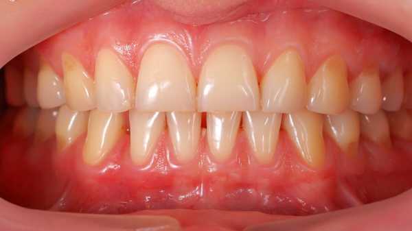 最健康牙齿（健康牙齿的标准颜色）-图3