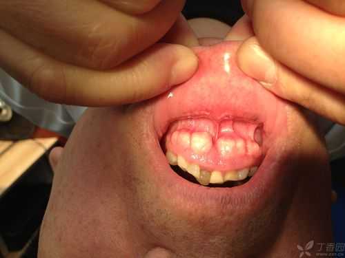 牙槽骨健康（牙槽骨疾病）