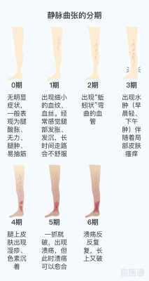 腿部观健康（腿部健康的重要性）-图2